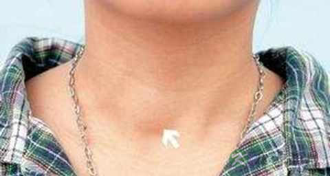 乳头状癌手术后的寿命 乳头状癌手术后的寿命