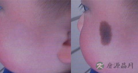 胎记激光后要注意什么 胎记激光后要注意什么