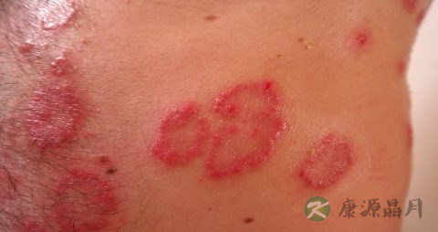 胎记手术什么时候做好 胎记手术什么时候做好