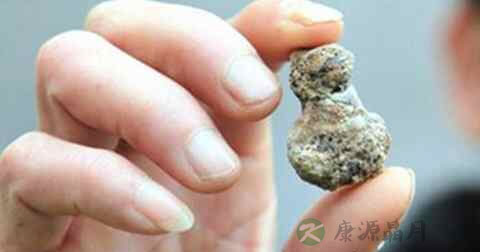 肾结石怎么排出 肾结石怎么排出