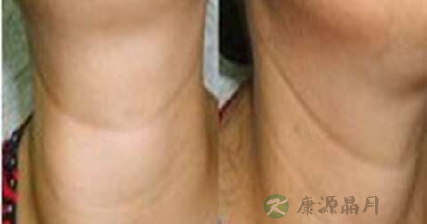 甲亢药物会影响肾常规吗 甲亢药物会影响肾常规吗