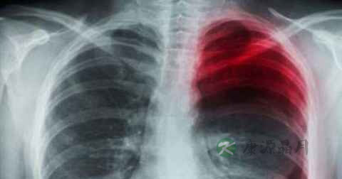 肺癌咳嗽怎么办 肺癌咳嗽怎么办