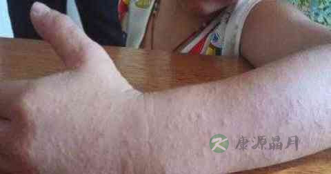过敏治疗的误区 过敏治疗的误区