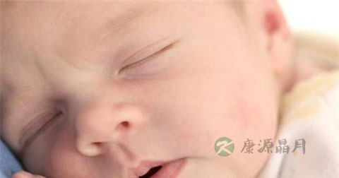 新生儿融血黄疸怎么办 新生儿融血黄疸怎么办