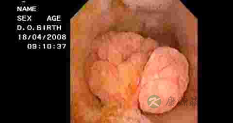 胆囊增大是怎么回事 胆囊增大是怎么回事