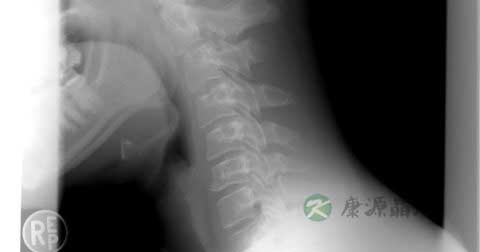 颈椎神经损伤怎么治 颈椎神经损伤怎么治