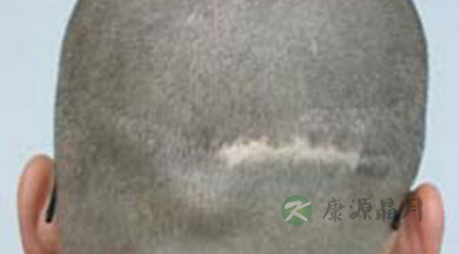 疤痕性脱发怎么办 疤痕性脱发怎么办