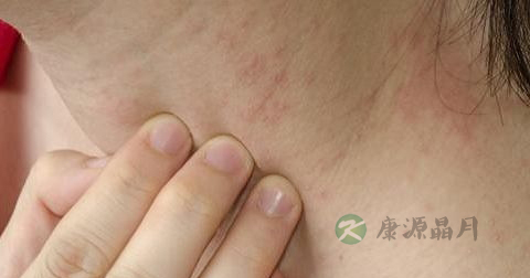 身上起小血点怎么办 身上起小血点怎么办