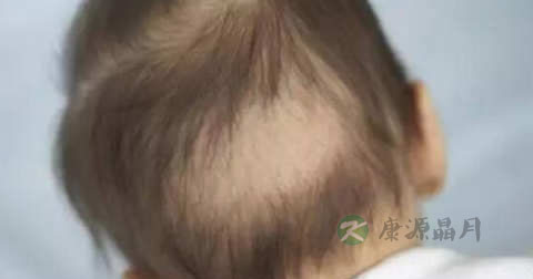 后脑勺出汗怎么办 后脑勺出汗怎么办