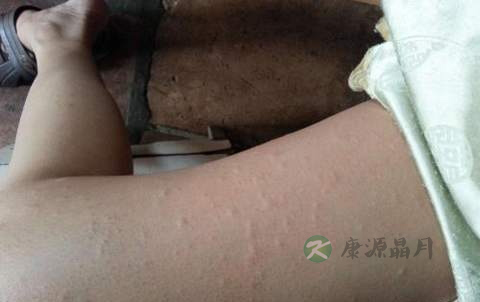 男人大腿内侧痒怎么办 男人大腿内侧痒怎么办