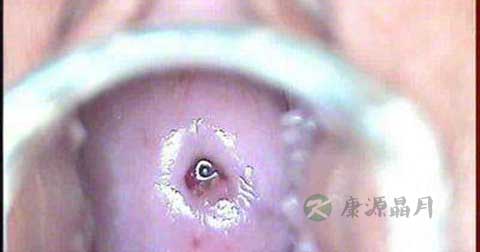 宫颈微波还需要打针吗 宫颈微波还需要打针吗