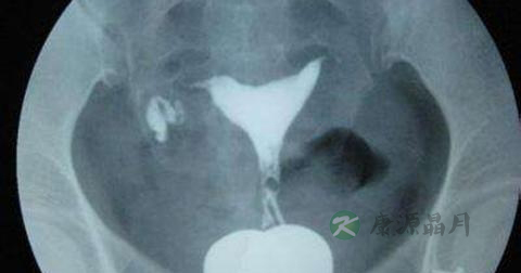 做子宫通水一定要消炎吗 做子宫通水一定要消炎吗