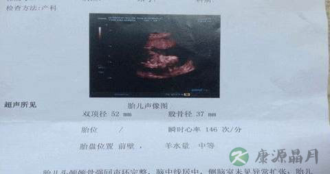 b超单能看出胎儿性别吗 b超单能看出胎儿性别吗