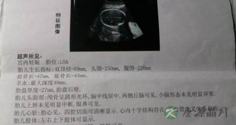 b超单能看出胎儿性别吗 b超单能看出胎儿性别吗
