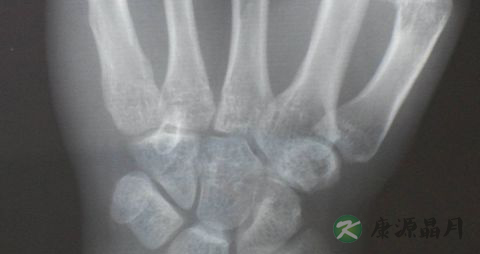 手腕疼痛是怎么回事 手腕疼痛是怎么回事
