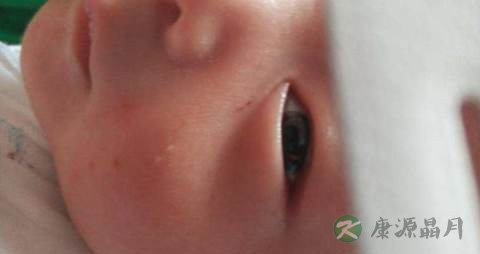 儿童起疹子要挂什么科 儿童起疹子要挂什么科