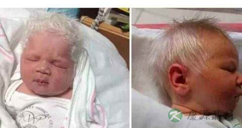 新生儿怎么确诊白化病 新生儿怎么确诊白化病