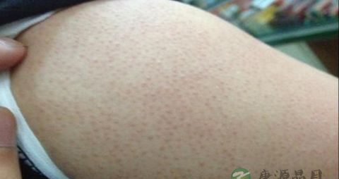 毛周角化症怎么治 毛周角化症怎么治