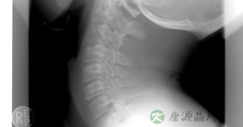 哪些舞蹈动作预防颈椎腰椎病 哪些舞蹈动作预防颈椎腰椎病