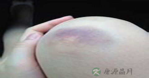 跳舞膝盖跪青紫怎么办 跳舞膝盖跪青紫怎么办