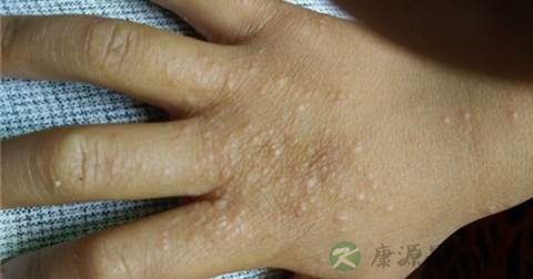手背上起小疙瘩的原因 手背上起小疙瘩的原因