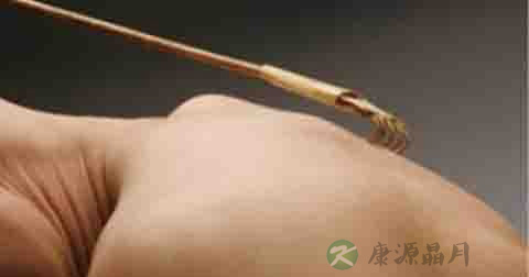 什么是亚急性皮炎 什么是亚急性皮炎