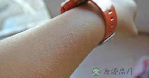皮炎为什么晚上痒和红 皮炎为什么晚上痒和红