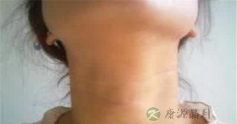 咽炎气管炎看什么科 咽炎气管炎看什么科