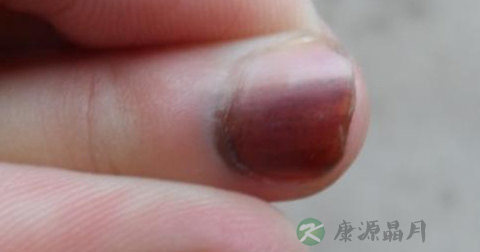 手指甲发白的原因 手指甲发白的原因