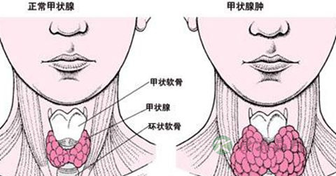 甲状腺异位能治好吗 甲状腺异位能治好吗