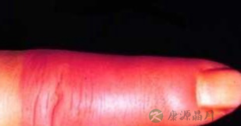 丹毒皮肤有哪些表现 丹毒皮肤有哪些表现