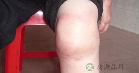 骨质增生属于什么科 骨质增生属于什么科