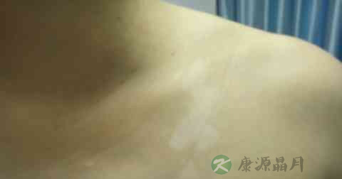 白癜风复发的原因是什么 白癜风复发的原因是什么