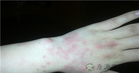 皮炎为什么不能喝酒 皮炎为什么不能喝酒