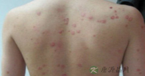 肢端皮炎怎么回事 肢端皮炎怎么回事