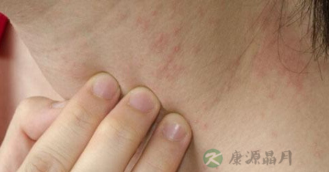 丹毒皮肤有哪些表现 丹毒皮肤有哪些表现