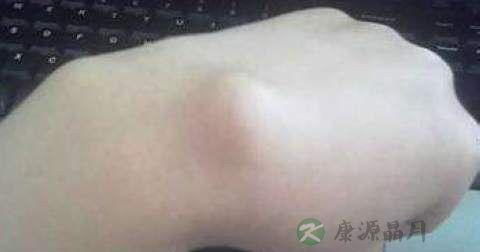 皮炎囊肿是怎么形成的 皮炎囊肿是怎么形成的