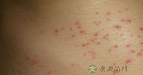 毛囊炎复发的原因 毛囊炎复发的原因