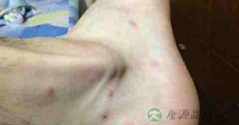 什么是亚急性皮炎 什么是亚急性皮炎