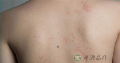 丘疹是什么引起的