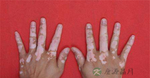 白癜风长在臀部正常吗 白癜风长在臀部正常吗
