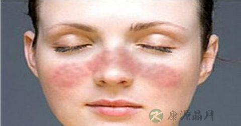 皮炎平小孩可以用吗 皮炎平小孩可以用吗