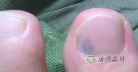 甲藓用什么药好 甲藓用什么药好
