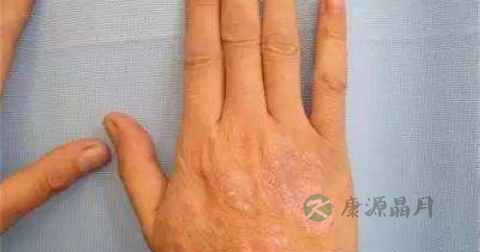 皮癣什么药最好 皮癣什么药最好