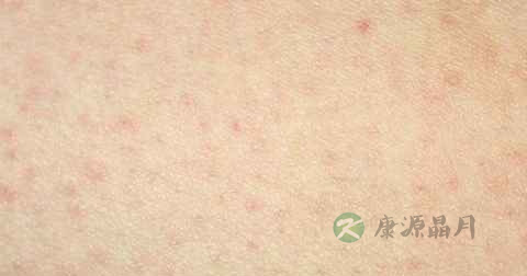 皮癣什么药最好 皮癣什么药最好