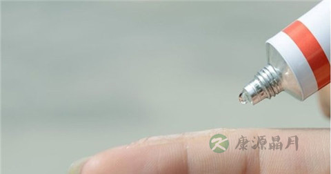 牛皮癣要用什么药才会好 牛皮癣要用什么药才会好