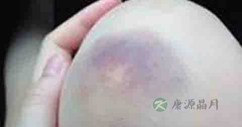 淤青用什么药散得快 淤青用什么药散得快