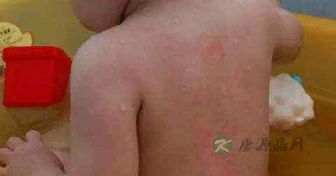疫苗接种注意事项 疫苗接种注意事项