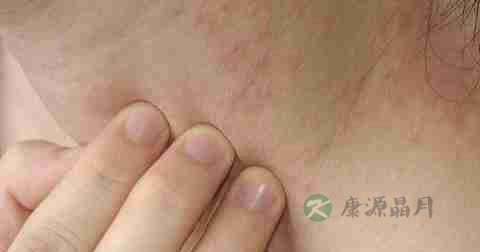 皮炎用药后痒正常吗 皮炎用药后痒正常吗