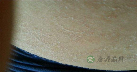 玫瑰糠疹能擦皮炎平吗